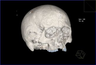 CT-Scan des Schädels (York Archaeological Trust)