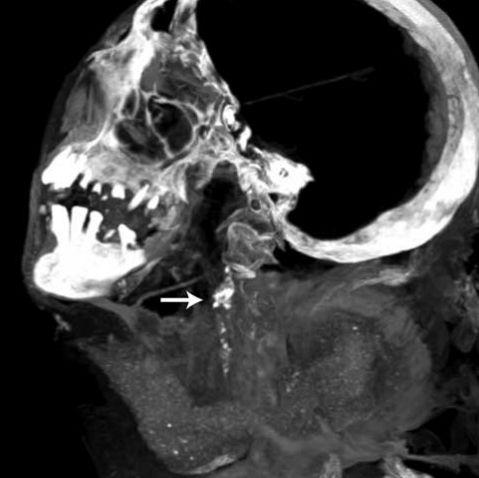 Der Pfeil deutet auf eine Verkalkung in der linken Carotis-Arterie (Michael Miyamoto)