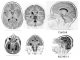 Magnetresonanztomografien eines gesunden Gehirns (oben) und eines Gehirns mit Mikrozephalie (unten) (Courtesy of Yale University School of Medicine)