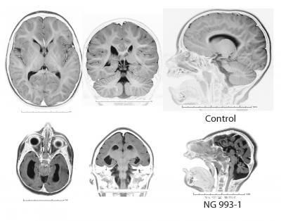 Magnetresonanztomografien eines gesunden Gehirns (oben) und eines Gehirns mit Mikrozephalie (unten) (Courtesy of Yale University School of Medicine)