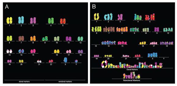 Ein normaler menschlicher Karyotyp mit exakt zwei duplizierten Chromosomen (links) und der Karyotyp einer Blasenkrebszelle mit mehrfachen Duplikaten, fehlenden Chromosomen und unvollständigen Chromsomen (rechts) (P. Duesberg / Univ. Berkeley)