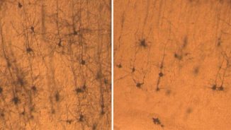 Neuronen einer normalen Maus (links) sind länger und voller als Neuronen einer Maus, die einen Mangel an SNX27 aufweist. (Sanford Burnham Medical Research Institute)