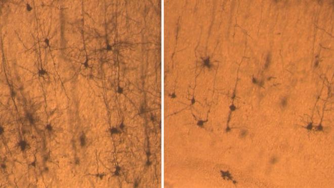 Neuronen einer normalen Maus (links) sind länger und voller als Neuronen einer Maus, die einen Mangel an SNX27 aufweist. (Sanford Burnham Medical Research Institute) Neuronen einer normalen Maus (links) sind länger und voller als Neuronen einer Maus, die einen Mangel an SNX27 aufweist. (Sanford Burnham Medical Research Institute)