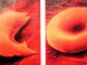 Ein sichelförmiges rotes Blutkörperchen (links) im Vergleich zu einem normalen roten Blutkörperchen (rechts). (Carnegie Institution for Science)