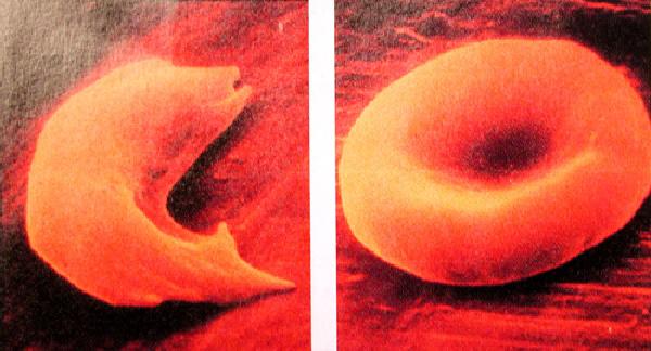 Ein sichelförmiges rotes Blutkörperchen (links) im Vergleich zu einem normalen roten Blutkörperchen (rechts). (Carnegie Institution for Science) Ein sichelförmiges rotes Blutkörperchen (links) im Vergleich zu einem normalen roten Blutkörperchen (rechts). (Carnegie Institution for Science)