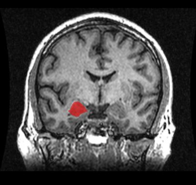 MRI-Scan eines menschlichen Gehirns mit eingefärbter Amygdala (nur einer der paarig vorhandenen so genannten Mandelkerne ist rot gekennzeichnet (Amber Rieder, Jenna Traynor, Geoffrey B Hall / Wikimedia Commons / CC0) MRI-Scan eines menschlichen Gehirns mit eingefärbter Amygdala (nur einer der paarig vorhandenen so genannten Mandelkerne ist rot gekennzeichnet (Amber Rieder, Jenna Traynor, Geoffrey B Hall / Wikimedia Commons / CC0)