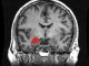 MRI-Scan eines menschlichen Gehirns mit eingefärbter Amygdala (nur einer der paarig vorhandenen so genannten Mandelkerne ist rot gekennzeichnet (Amber Rieder, Jenna Traynor, Geoffrey B Hall / Wikimedia Commons / CC0)