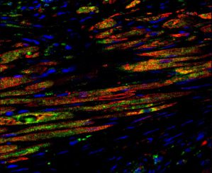 Bei diesem Bild zeigt Grün die von den transplantierten Stammzellen neugebildeten Myozyten. Rot stellt Myozyten dar, Blau die Zellkerne. Rot und Grün zusammen bedeutet, dass die transplantierten Stammzellen neue Myozyten gebildet haben. (Journal of the American College of Cardiology / Elsevier)