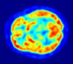 Transaxialer PET-Scan eines menschlichen Gehirns. (Credits: Wikipedia Commons / Jens Maus / gemeinfrei)