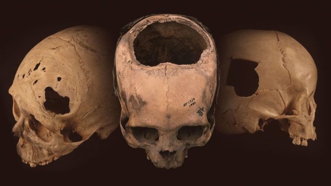 Prähistorische Schädel mit Trepanationslöchern. (Credit: University of Miami)